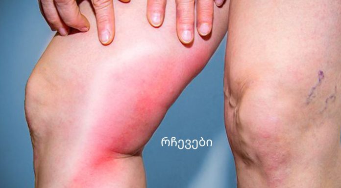 თრომბოზის საშიში ნიშნები, რომლებმაც შეიძლება მოგკლათ!