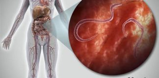 ორგანიზმში პარაზიტების ნიშნები და როგორ მოვიშოროთ ისინი