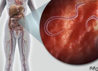 ორგანიზმში პარაზიტების ნიშნები და როგორ მოვიშოროთ ისინი