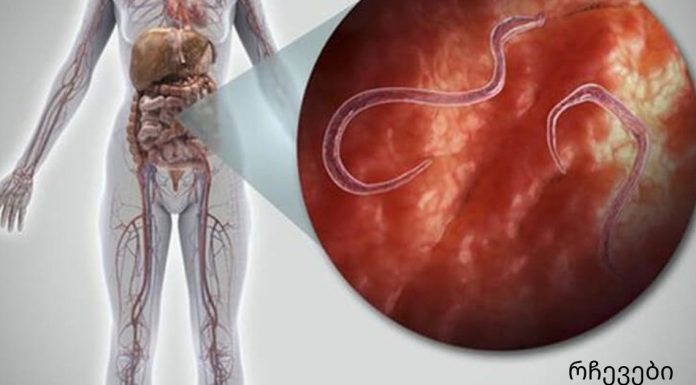 ორგანიზმში პარაზიტების ნიშნები და როგორ მოვიშოროთ ისინი