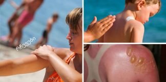 როგორ ავიცილოთ თავიდან მზის დამწვრობა, დამწვრობის მკურნალობა: ხალხური რეცეპტები.