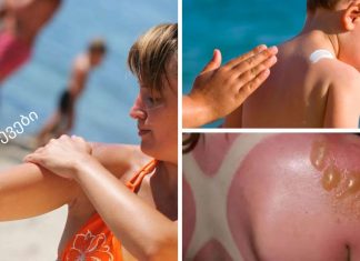 როგორ ავიცილოთ თავიდან მზის დამწვრობა, დამწვრობის მკურნალობა: ხალხური რეცეპტები.