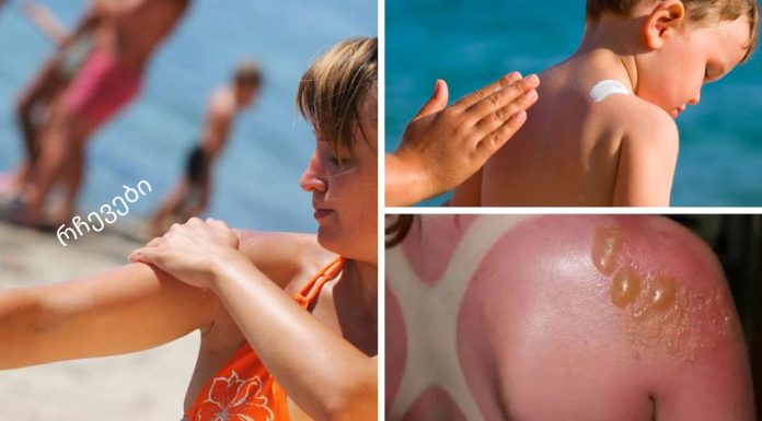 როგორ ავიცილოთ თავიდან მზის დამწვრობა, დამწვრობის მკურნალობა: ხალხური რეცეპტები.