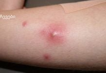 კანზე როგორც კი სიმაგრეს შეამჩნევთ ეს გააკეთეთ აუცილებლად.ფურუნკულები და მათი მკურნალობა სახლში