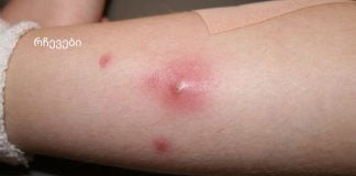 კანზე როგორც კი სიმაგრეს შეამჩნევთ ეს გააკეთეთ აუცილებლად.ფურუნკულები და მათი მკურნალობა სახლში