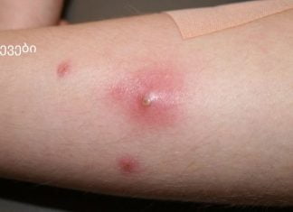 კანზე როგორც კი სიმაგრეს შეამჩნევთ ეს გააკეთეთ აუცილებლად.ფურუნკულები და მათი მკურნალობა სახლში