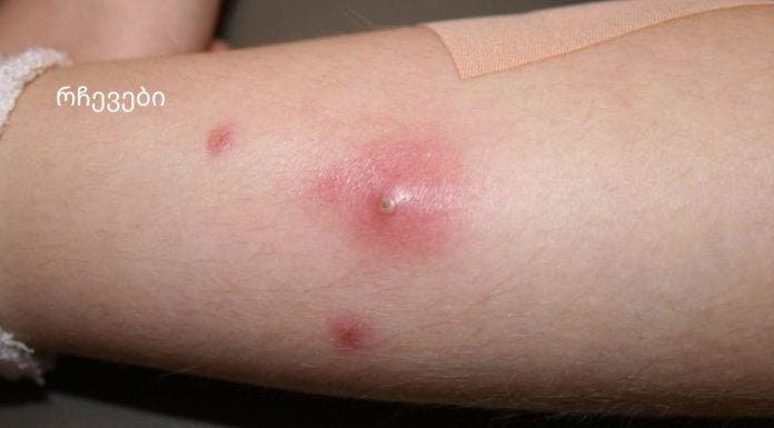 კანზე როგორც კი სიმაგრეს შეამჩნევთ ეს გააკეთეთ აუცილებლად.ფურუნკულები და მათი მკურნალობა სახლში