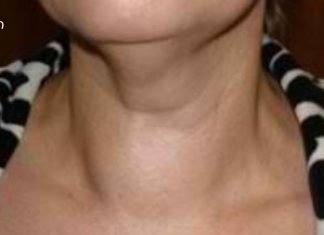 ფარისებრი ჯირკვლის ჩიყვი: სიმპტომები და მკურნალობა ხალხური საშუალებებით