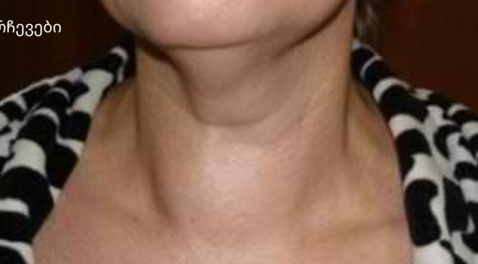 ფარისებრი ჯირკვლის ჩიყვი: სიმპტომები და მკურნალობა ხალხური საშუალებებით