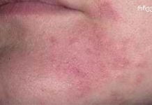 დერმატიტი – მკურნალობა ხალხური საშუალებებით