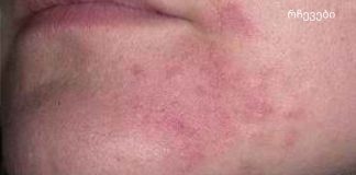 დერმატიტი – მკურნალობა ხალხური საშუალებებით