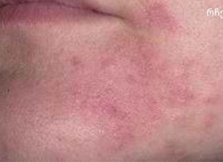 დერმატიტი – მკურნალობა ხალხური საშუალებებით