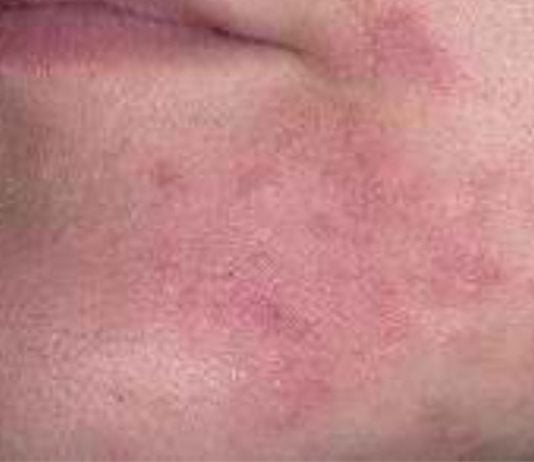 დერმატიტი – მკურნალობა ხალხური საშუალებებით