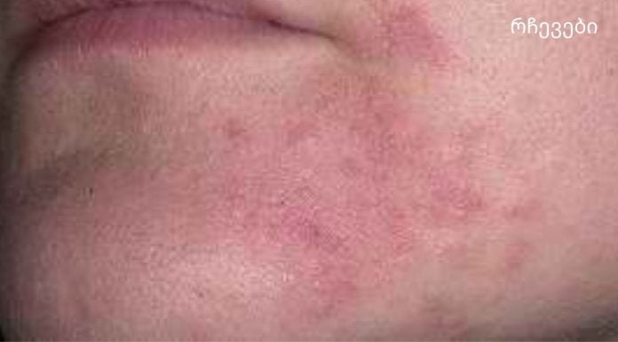 დერმატიტი – მკურნალობა ხალხური საშუალებებით