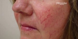 სხეულზე სისხლძარღვთა ვარსკვლავები მნიშვნელოვანი გამაფრთხილებელი ნიშანია