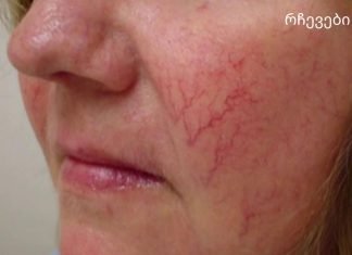 სხეულზე სისხლძარღვთა ვარსკვლავები მნიშვნელოვანი გამაფრთხილებელი ნიშანია