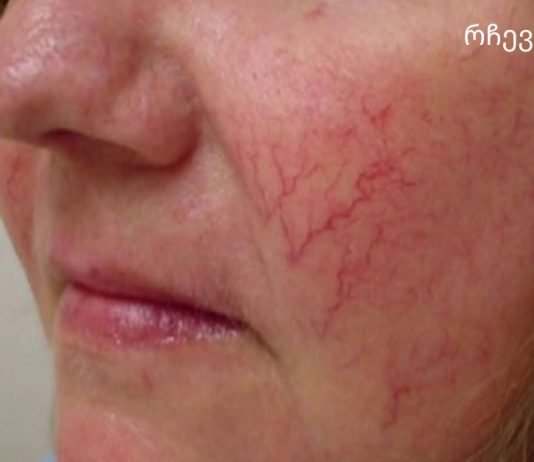 სხეულზე სისხლძარღვთა ვარსკვლავები მნიშვნელოვანი გამაფრთხილებელი ნიშანია