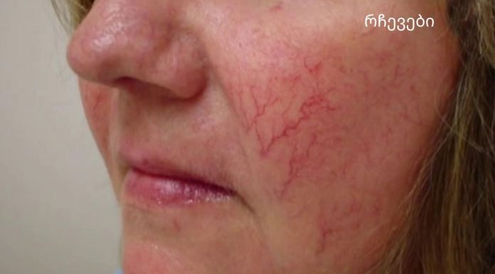 სხეულზე სისხლძარღვთა ვარსკვლავები მნიშვნელოვანი გამაფრთხილებელი ნიშანია