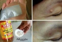 როგორ მოვიშოროთ მეჭეჭები