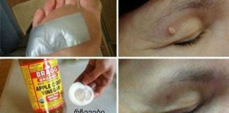 როგორ მოვიშოროთ მეჭეჭები