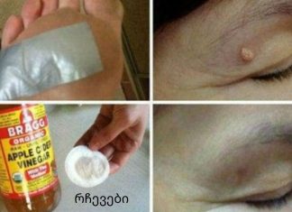 როგორ მოვიშოროთ მეჭეჭები