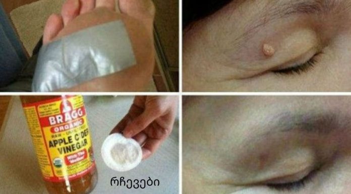 როგორ მოვიშოროთ მეჭეჭები