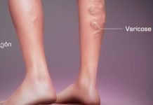 ნახეთ ვარიკოუზლი ვენების თერაპიული ვარჯიშები