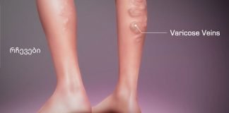 ნახეთ ვარიკოუზლი ვენების თერაპიული ვარჯიშები