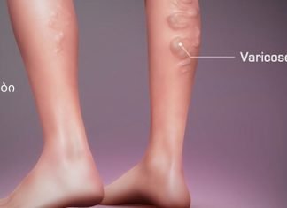 ნახეთ ვარიკოუზლი ვენების თერაპიული ვარჯიშები