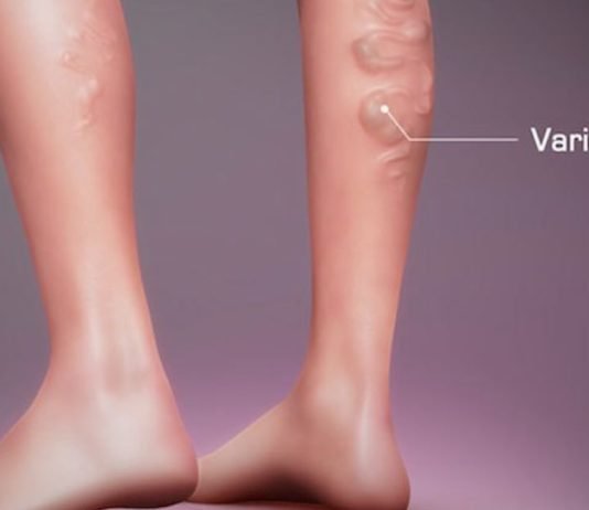 ნახეთ ვარიკოუზლი ვენების თერაპიული ვარჯიშები