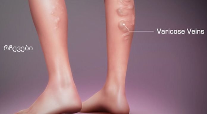 ნახეთ ვარიკოუზლი ვენების თერაპიული ვარჯიშები