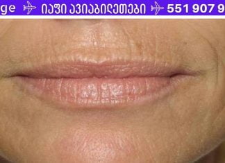 წარმოუდგენელი! ეს მეთოდი ძალიან სწრაფად დაეხმარა ტუჩის ზემოთ ნაოჭების მოშორებას!