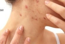 როგორ მოვიშოროთ სწრაფად სახლში ჰემატომები( სისხლჩაქცევები) სახეზე და სხეულზე