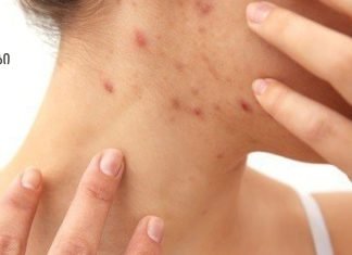 როგორ მოვიშოროთ სწრაფად სახლში ჰემატომები( სისხლჩაქცევები) სახეზე და სხეულზე