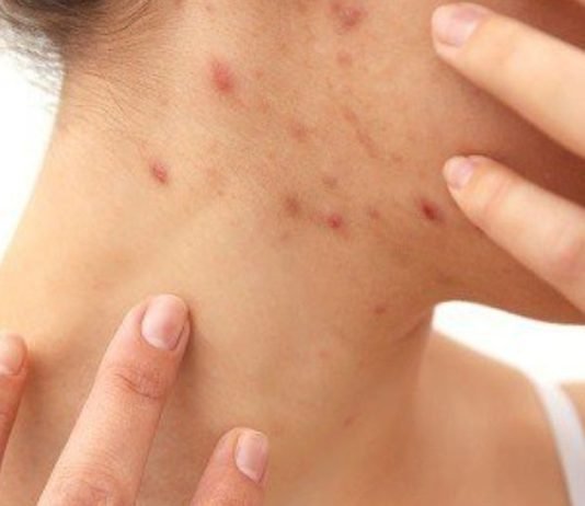 როგორ მოვიშოროთ სწრაფად სახლში ჰემატომები( სისხლჩაქცევები) სახეზე და სხეულზე