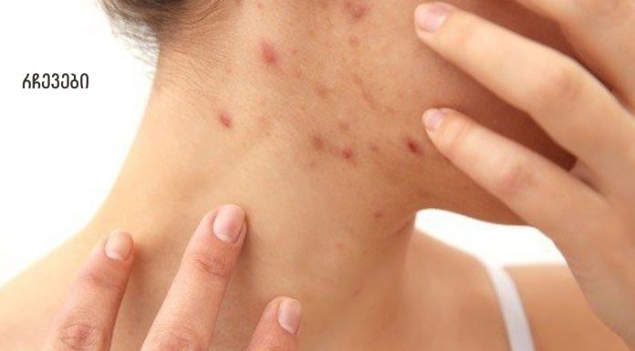 როგორ  მოვიშოროთ სწრაფად სახლში ჰემატომები( სისხლჩაქცევები) სახეზე და სხეულზე
