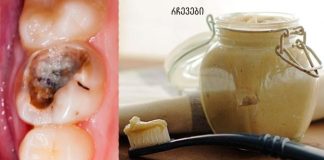 ეს 5 ხრიკი დაგეხმარებათ გათავისუფლდეთ კბილებთან დაკავშირებული მრავალი პრობლემისგან!