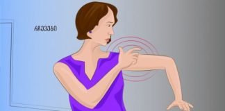 ინსულტის სიმპტომები, რომლებიც ქალებმა ყველაზე მეტად უნდა იცოდნენ