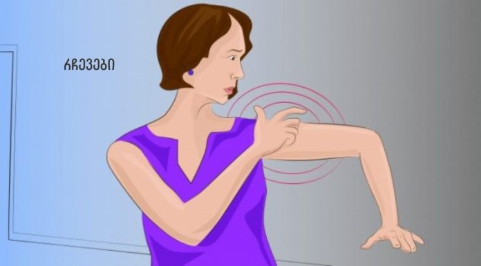 ინსულტის სიმპტომები, რომლებიც ქალებმა ყველაზე მეტად უნდა იცოდნენ