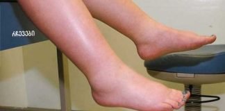 მე გამუდმებით ვიტანჯებოდი ფეხების შეშუპებით,სანამ არ შევისწავლე ამ სასწაული სახლში მომზადებული ჩაის შესახებ.შეშუპება გაქრა რამდენიმე დღეში და აღარ აწუხებს!