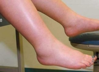 მე გამუდმებით ვიტანჯებოდი ფეხების შეშუპებით,სანამ არ შევისწავლე ამ სასწაული სახლში მომზადებული ჩაის შესახებ.შეშუპება გაქრა რამდენიმე დღეში და აღარ აწუხებს!