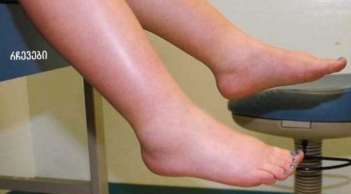 მე გამუდმებით ვიტანჯებოდი ფეხების შეშუპებით,სანამ არ შევისწავლე ამ სასწაული სახლში მომზადებული ჩაის შესახებ.შეშუპება გაქრა რამდენიმე დღეში და აღარ აწუხებს!