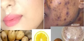 მოიშორეთ მუქი ლაქები და აკნეს ნაწიბურები სახეზე!