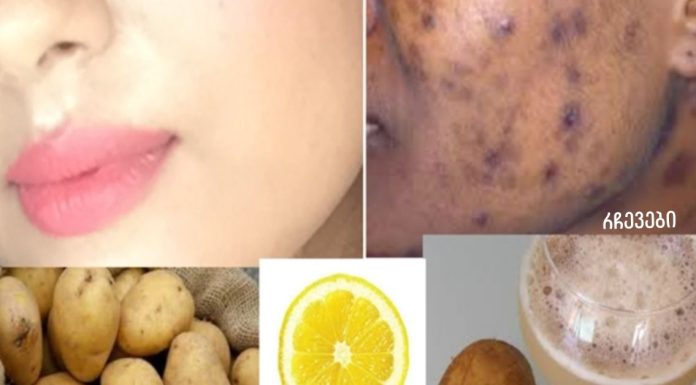 მოიშორეთ მუქი ლაქები და აკნეს ნაწიბურები სახეზე!