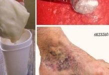 სცადეთ ეს ჯადოსნური საშუალება ვარიკოზული ვენებისა და თრომბოზებისთვის! მხოლოდ 2 მარტივი ინგრედიენტი.