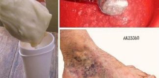 სცადეთ ეს ჯადოსნური საშუალება ვარიკოზული ვენებისა და თრომბოზებისთვის! მხოლოდ 2 მარტივი ინგრედიენტი.