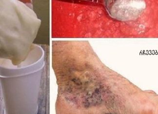 სცადეთ ეს ჯადოსნური საშუალება ვარიკოზული ვენებისა და თრომბოზებისთვის! მხოლოდ 2 მარტივი ინგრედიენტი.