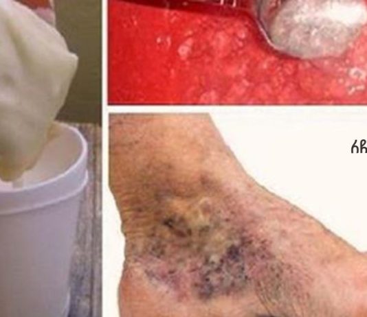 სცადეთ ეს ჯადოსნური საშუალება ვარიკოზული ვენებისა და თრომბოზებისთვის! მხოლოდ 2 მარტივი ინგრედიენტი.