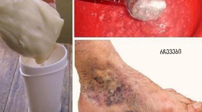 სცადეთ ეს ჯადოსნური საშუალება ვარიკოზული ვენებისა და თრომბოზებისთვის! მხოლოდ 2 მარტივი ინგრედიენტი.