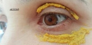 5 დღის განმავლობაში თვალის ირგვლივ კურკუმას ისვამდა! და ასეც მოხდა!